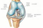 膝關節半月板損傷