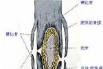 慢性骨髓炎 M86.691 慢性化膿性骨髓炎