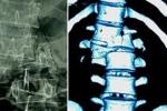 脊柱骨折 T08.X051 Spinal fractures