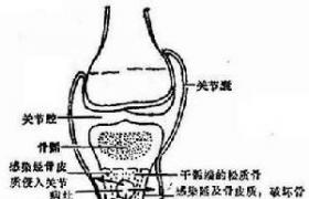 化膿性骨髓炎 M86.997 附骨疽