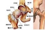 酒精性股骨頭壞死 Osteonecrosis of the femoral head