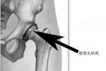 酒精性股骨頭壞死 Osteonecrosis of the femoral head