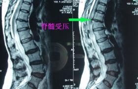 腰椎管狹窄 腰椎狹窄椎管狹窄