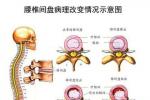 腰椎管狹窄 腰椎狹窄椎管狹窄