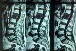 脊柱壓縮性骨折 垂直壓縮性骨折