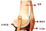 膝關節內側副韌帶斷裂