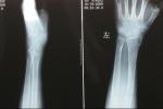 橈骨遠端骨折 Colles骨折 伸直型橈骨下端骨折