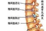 慢性腰背痛 腰痹