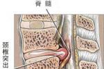 頸椎間盤突出癥