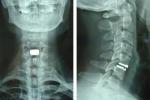 頸椎後縱韌帶骨化癥 頸椎後縱韌帶骨化日本人病