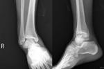 踝關節脫位 S93.002 踝骨脫 腳踝骱出 腳盤出臼