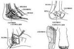 跟骨骨刺綜合征 跟骨痹