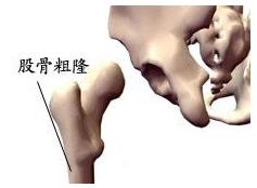 股骨粗隆間骨折 S72.101 