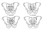 骶骨骨折 S32.101 