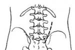 第三腰椎橫突綜合征
