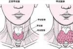 甲狀腺癌 惡性甲狀腺腫 石癭