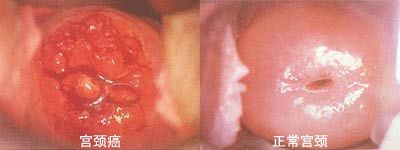 宮頸癌前病變
