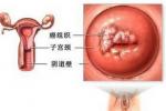 宮頸癌前病變