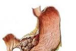 胃腸道間質瘤 GIST