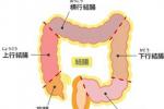 結直腸癌 大腸癌