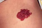 草莓狀血管瘤 草莓狀毛細血管瘤 草莓毛細血管瘤