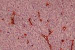 惡性血管內皮細胞瘤 M91300 3 血管肉瘤