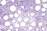 皮下T細胞淋巴瘤 脂膜炎樣T細胞淋巴瘤