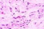 匍行性血管瘤 Angioma serpiginosum