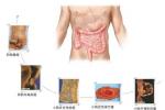 小腸腺癌 系膜小腸癌