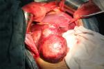 肝腫瘤 肝臟腫瘤
