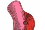 主動脈假性動脈瘤 主動脈夾層分離 壁間血腫主動脈夾層動脈