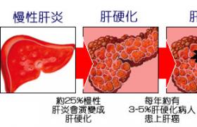 肝癌 原發性肝癌