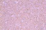 神經纖維瘤 神經膜瘤 神經瘤 神經周圍纖維瘤 雪旺細胞瘤 神經周圍纖維母細胞瘤