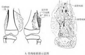 骨肉瘤 成骨肉瘤 骨源性肉瘤 原發惡性梭形細胞腫瘤