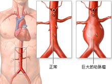 動脈瘤 I72.901 