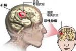 顱內腫瘤 中樞神經系統腫瘤 腦瘤 腦腫瘤