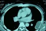 軟骨肉瘤 Chondrosarcoma of bone