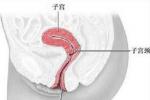 宮頸腺癌
