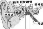 中耳癌 carcinoma of middle ear
