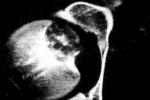 軟骨母細胞瘤 鈣化巨細胞瘤；骨骺軟骨性巨細胞瘤；含軟骨巨