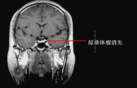 腦垂體瘤 垂體瘤垂體腺瘤腦垂體腺瘤