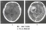 膠質細胞瘤 神經膠質瘤 神經外胚層腫瘤 神經上皮腫瘤
