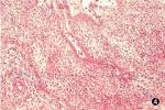 長骨造釉細胞瘤 長骨的成釉細胞瘤