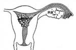 子宮頸肉瘤