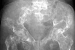 轉移性骨腫瘤 骨轉移性惡性腫瘤 骨的轉移瘤