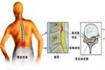 椎管內轉移性腫瘤 椎內轉移性腫瘤