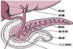 胰多肽瘤
