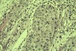 角膜鱗狀細胞癌 角膜扁平細胞癌 角膜鱗狀上皮細胞癌 角膜棘細胞癌 角膜鱗癌