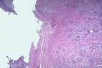 角膜鱗狀細胞癌 角膜扁平細胞癌 角膜鱗狀上皮細胞癌 角膜棘細胞癌 角膜鱗癌
