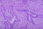 膀胱葡萄狀肉瘤 膀眈胱葡萄狀肉瘤膀胱橫紋肌肉瘤